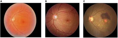 Classification of dry and wet macular degeneration based on the ConvNeXT model